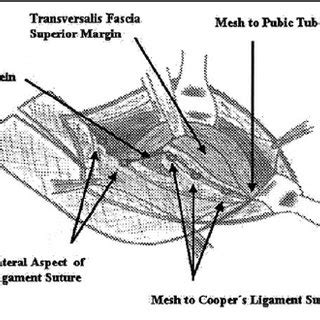 The mesh is sutured and anchored to the pubic bone, Cooper’s ligament ...