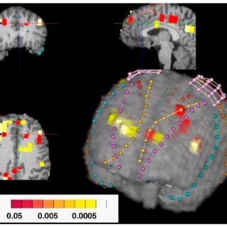 Post Registration Overlay Of A MRSI Statistical Parametric Map On The