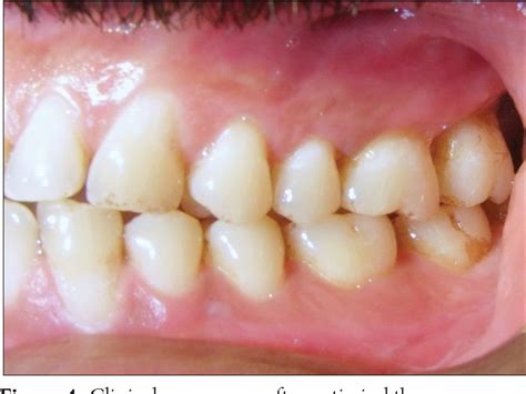 Herpetic Gingivostomatitis Gums