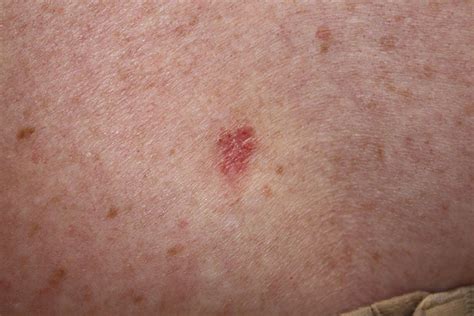 Basal Cell Carcinoma Pathophysiology Wikidoc