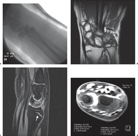 Growth Plate Radiology Key