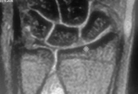 Scapholunate dissociation: MRI - Sumer's Radiology Blog