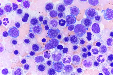 Pathology Outlines Megaloblastic Anemia