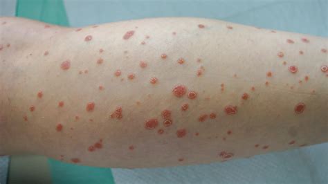 Psoriasis Guttata Causas Síntomas Y Tratamiento Uvtreat