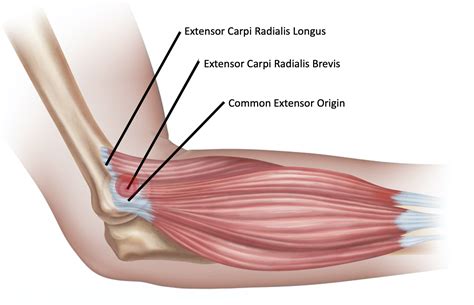 Tennis Elbow Lateral Epicondylitis Lothian Virtual Hand Clinic