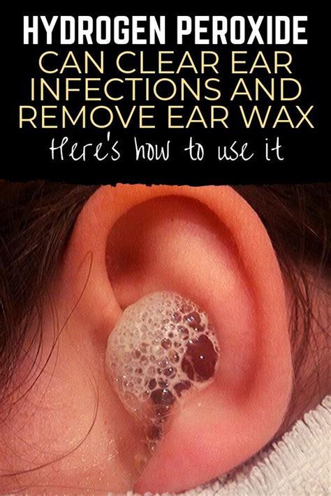 Hydrogen Peroxide Can Clear Ear Infections And Remove Ear Wax Heres How To Use It Natural