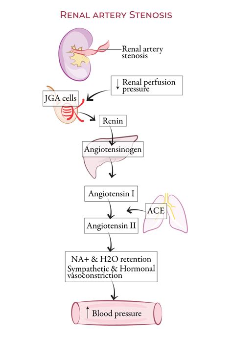 Usmle Comlex Step Glossary Renal Artery Stenosis For Usmle Step