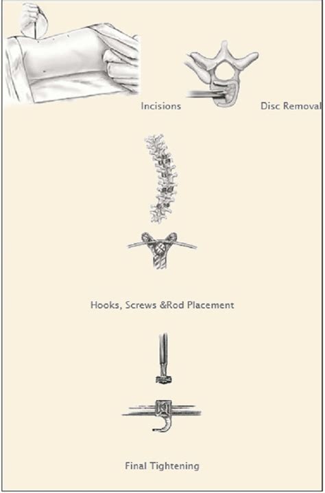 Anterior And Posterior Approach Spine Care Houston Tx Modern Spine