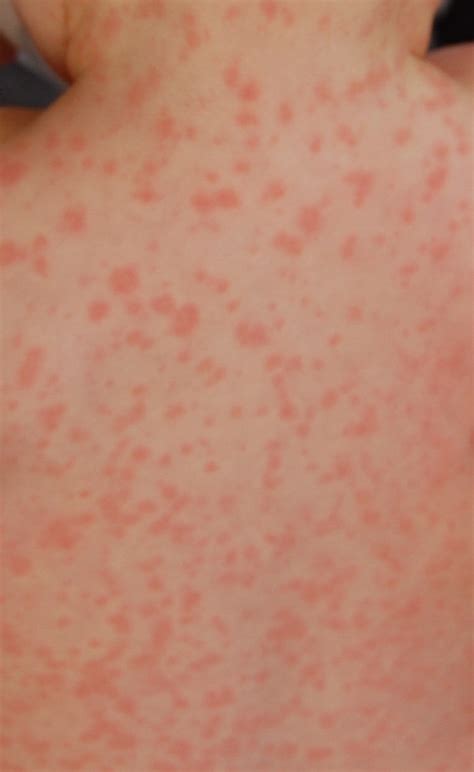 Quest For Health Antibiotic Allergy Or Just A Rash