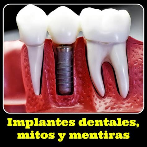 Implantes Dentales Mitos Y Mentiras Directorio Odontol Gico