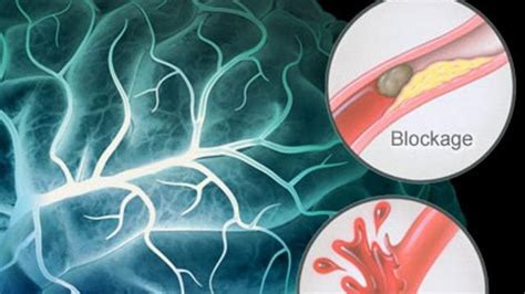 Foto Awas Stroke Mulai Mengintai Anak Muda