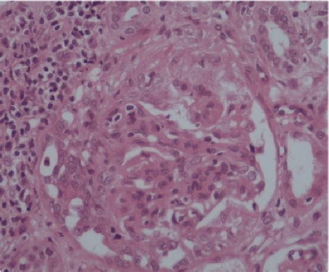 A Light Microscopy Fibro Cellular Crescent Formation And Mesangial