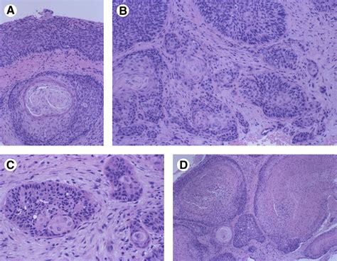 Squamous Cell Carcinoma Radiographically Resembling A Dentigerous Cyst Report Of A Case