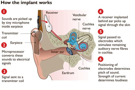 Cochlear Implant The Hearing Miracle The Blog Of Dato Dr Anuar Md Nor