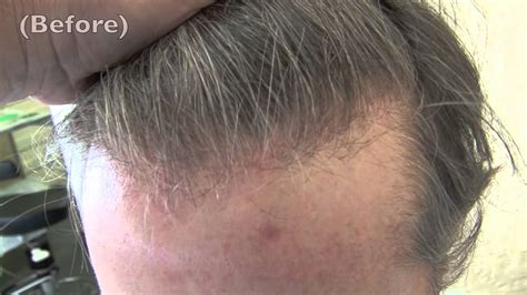 Grafts Hair Transplant Bidishamiya