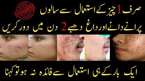 Face Pack For Pimple And Acne How To Remove Pimples Overnight Acne