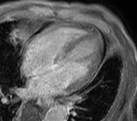 Cardiac Infarction With Fat Free Mdixon Imaging Philips Mr Body Map