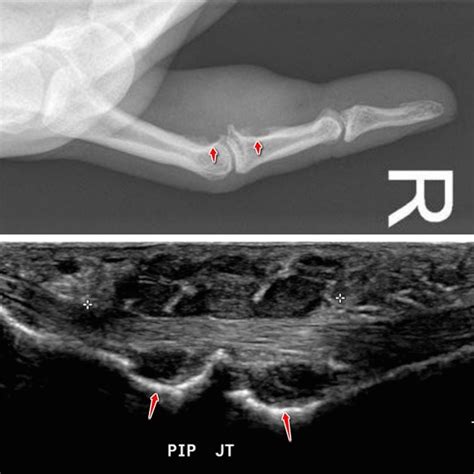 Giant Cell Tumor Of Tendon Sheath Ultrasound