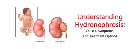 Demystifying Hydronephrosis Causes Symptoms And Treatment Solutions