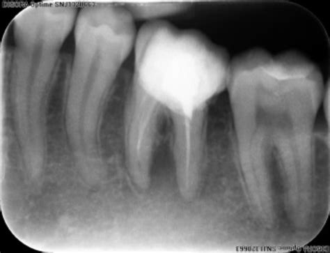 Preoperative Radiograph Of Tooth Showing Underobturated Root Canals