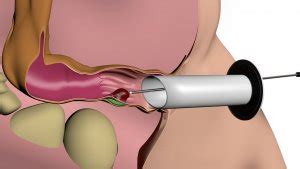 H Morrhoidentherapie Nach Rafaelo Chirurgie Und Enddarmpraxis