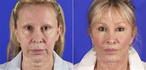 Mid Face Lift Beverly Hills Ca Dr Andrew Frankel