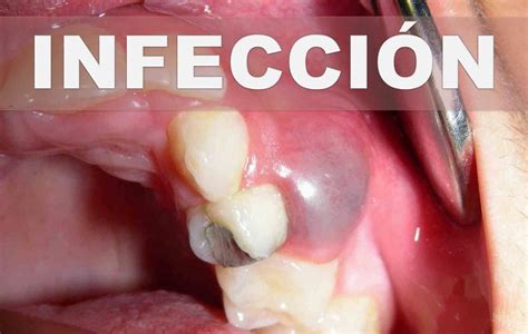 Remedios Caseros Para Un Absceso Dental Como Aliviar Infecci N En La