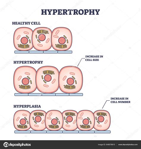 Diferen As Entre Hipertrofia E Hiperplasia Revoeduca
