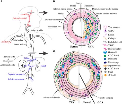 Takayasu Arteritis Histology