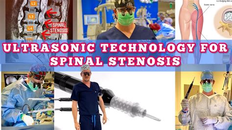 𝐔𝐥𝐭𝐫𝐚𝐬𝐨𝐧𝐢𝐜 Spine Surgery 𝐓𝐞𝐜𝐡𝐧𝐨𝐥𝐨𝐠𝐲 For Spinal Stenosis 😀🧐🥳 Youtube