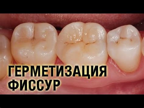 🟢 Герметизация фиссур - YouTube