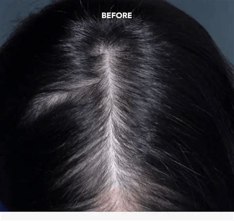 ROGAINE® for Women: Minoxidil Hair Regrowth Foam & Solution | ROGAINE®