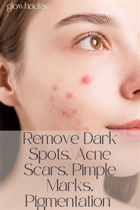 10 Ways To Reduce With Acne And Pimples Artofit