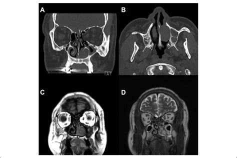 A And B Ct Scans Show Dense Soft Tissue Along The Left Inferior