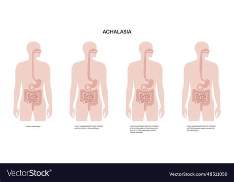 Esophageal Achalasia Disease Royalty Free Vector Image