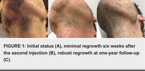 Alopecia Barbae Regrowth