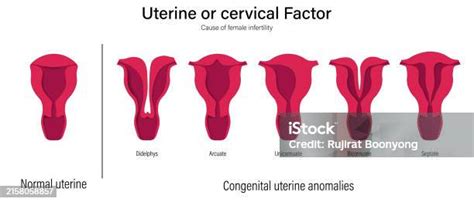 Female Infertility Vector Comparison Of Normal Uterine And Congenital