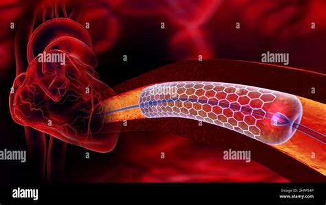 Cardiac Catheter With Stent Illustration Stock Photo Alamy