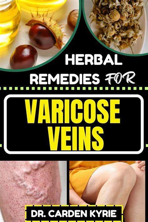 Jp Herbal Remedies For Varicose Veins Empower Your Veins