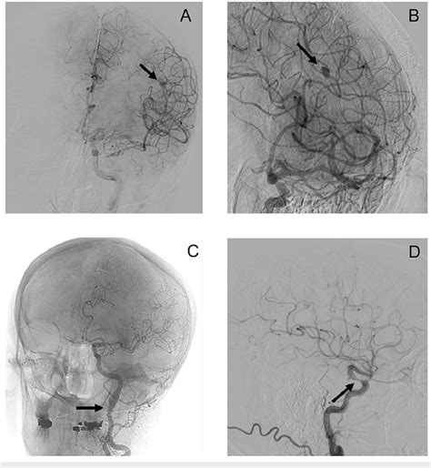 Diagnostic Cerebral Angiography A Anterior Posterior View Of Fusiform Download Scientific