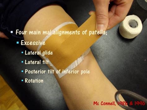 Taping For Patellofemoral Pain Syndrome