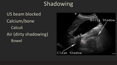 Ultrasound 101 Part 6 Artifacts That Help Usmp4 Youtube