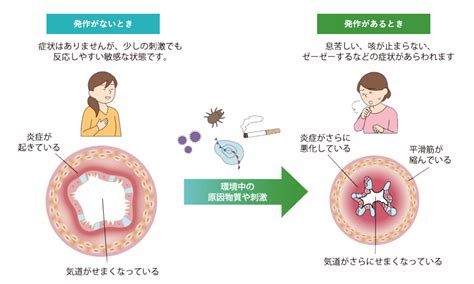 喘息とは｜喘息に関する情報サイト｜アレルギーi