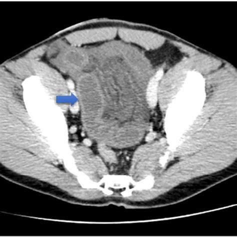 Axial Abdominal Ct Scan With Distended Small Bowel Loops Wall Edema Download Scientific Diagram