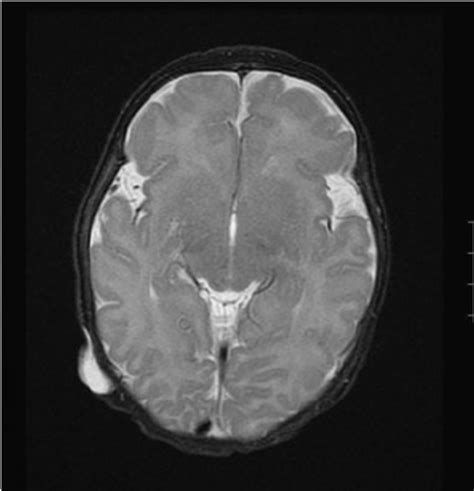 T2 Weighted Mri Noting The Right Sided Extracranial Csf Collection