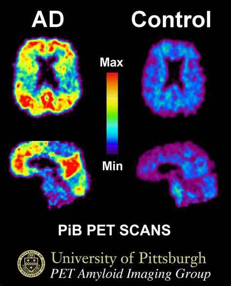 What the brain looks like when someone gets Alzheimer's - Business Insider