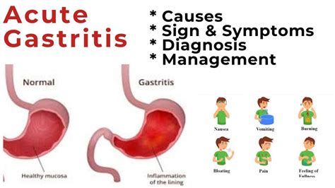 What Is Acute Gastritis Acute Gastritis In Hindi YouTube