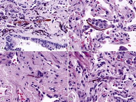 Asbestosis Thoracic Pathology A Volume In The High Yield Pathology