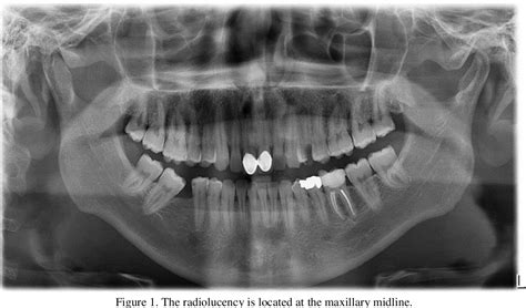 Figure 1 From Treatment Of A Secondarily Infected Nasopalatine Duct