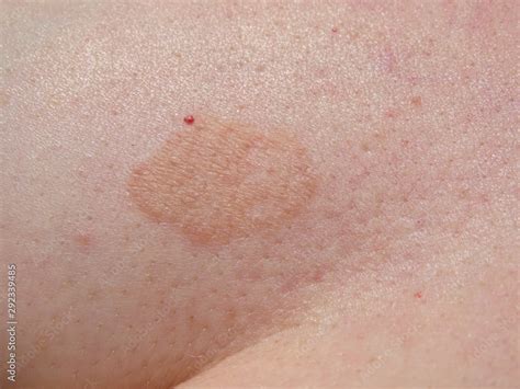 Fungal Skin Rash Infection Mark Close Up View Of The Patch Which Is Darker Than The Healthy